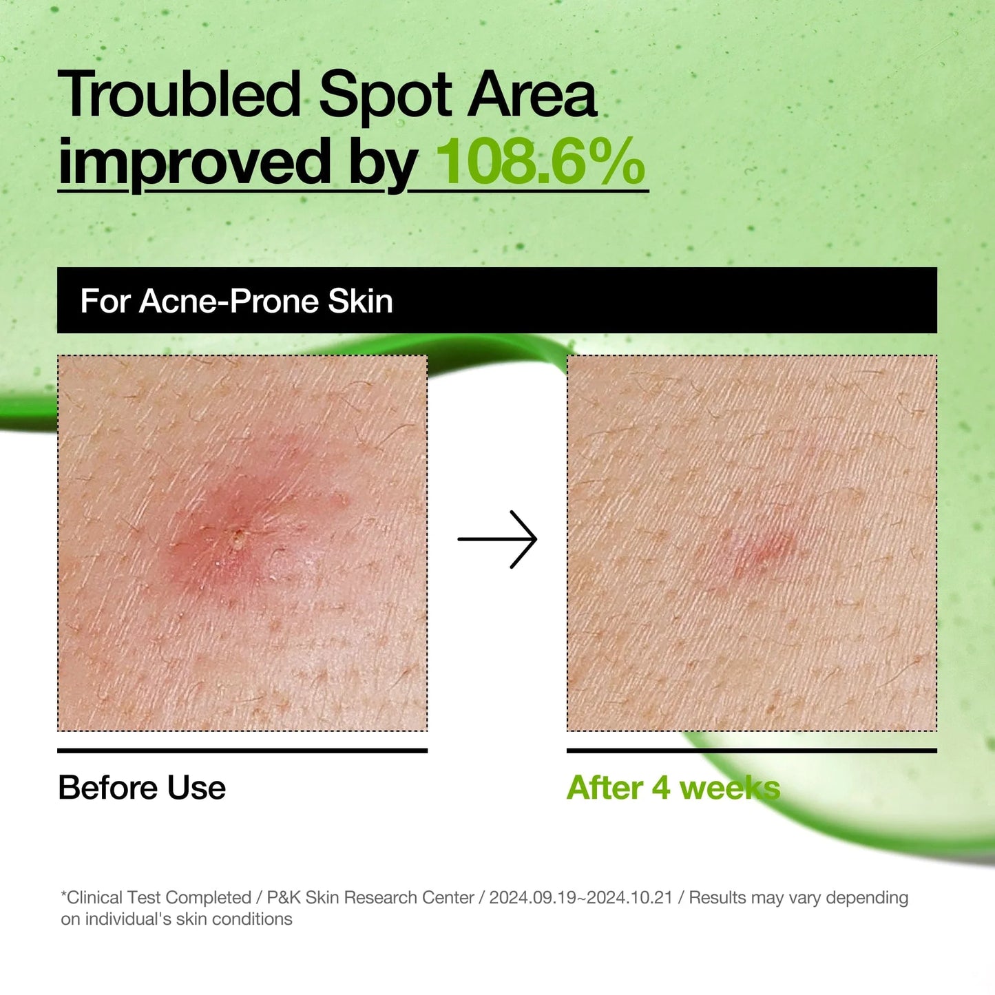 ANUA] Azelaic Acid 10 Hyaluron Redness Soothing Serum 30ml